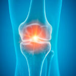 Inflammation dans le genou